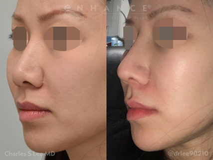 Rhinoplasty