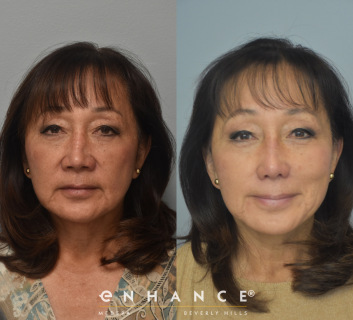 revision rhinoplasty