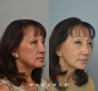 revison rhinoplasty