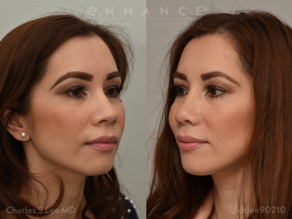 Rhinoplasty