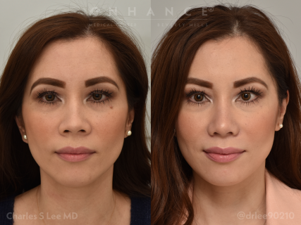 Rhinoplasty