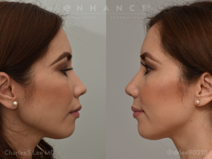 Rhinoplasty