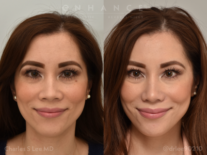 Rhinoplasty