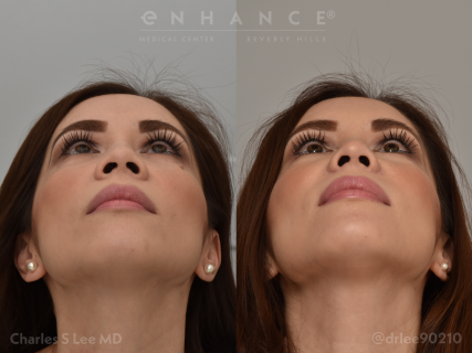 Rhinoplasty