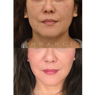 Threadlift