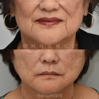 Threadlift