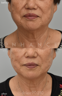 Threadlift