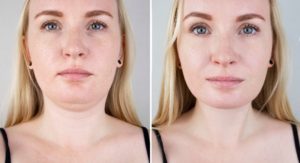 Facial Liposuction Beverly Hills