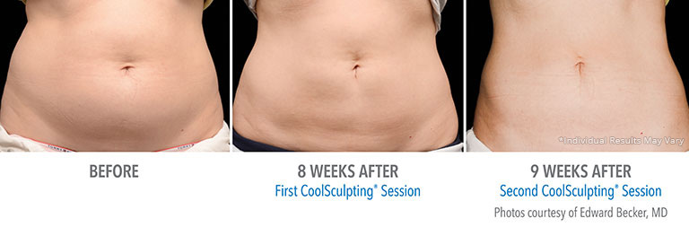 Coolsculpting Patient Beverly Hills