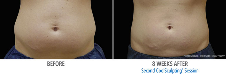 Coolsculpting Before After