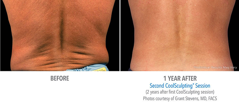 Lower Back Coolsculpting in Beverly Hills