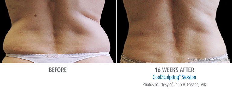 Lower Back Coolsculpting Patient Photos