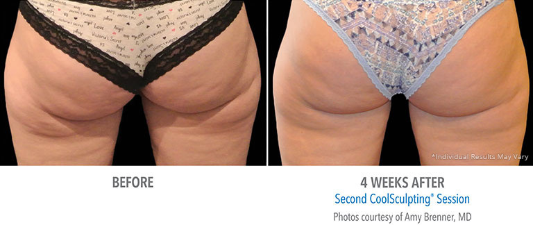 Fat Freezing Buttocks Patient in Beverly Hills
