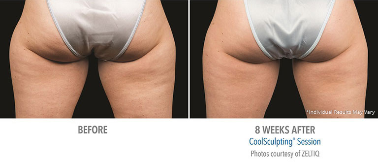 Butt Fat Freesing Patient in Beverly Hills