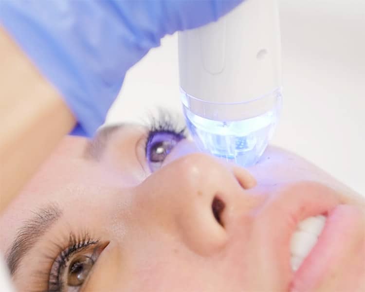 Vivace Microneedling beverly hills california