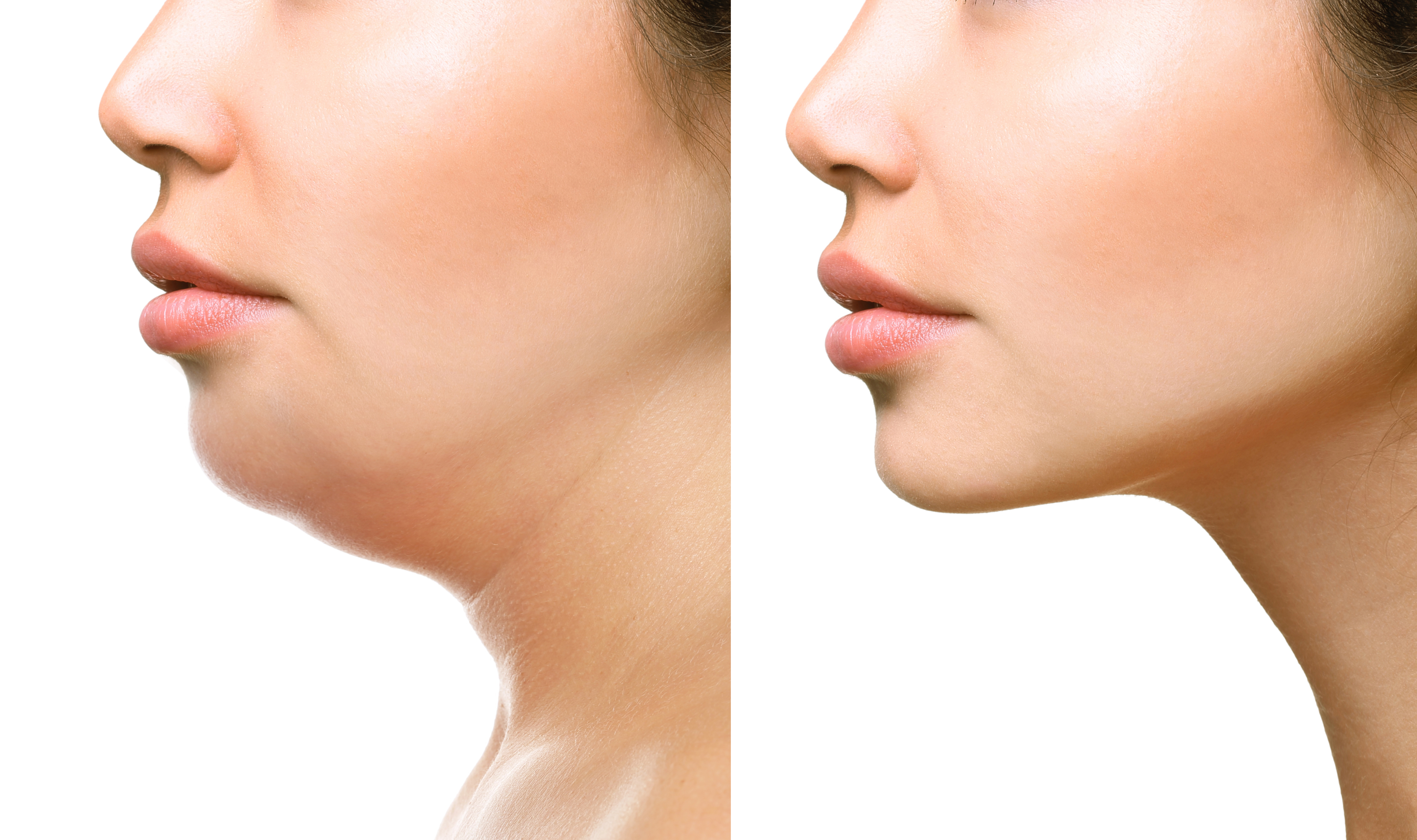 Kybella Treatment in Beverly Hills, CA