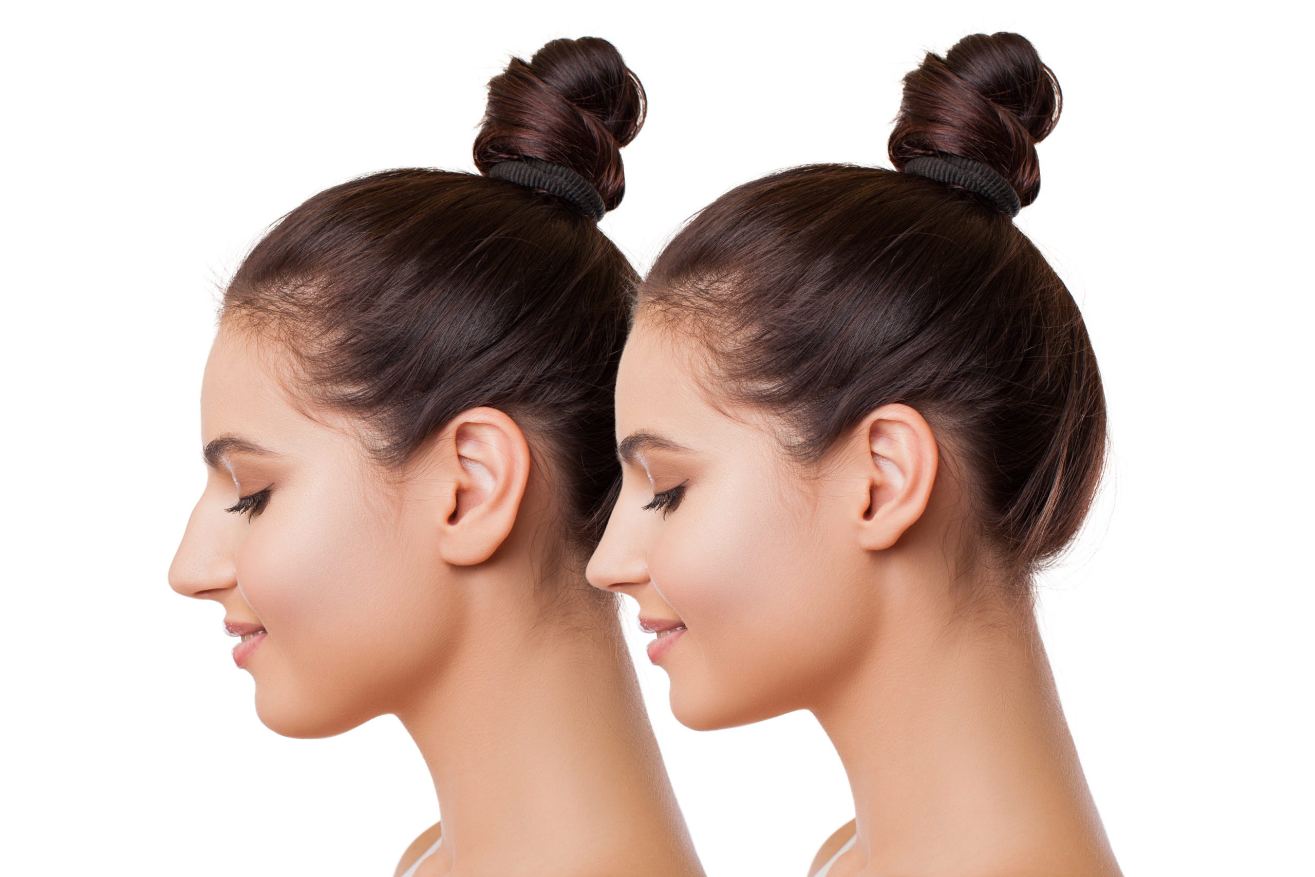 Revision Rhinoplasty in Beverly Hills