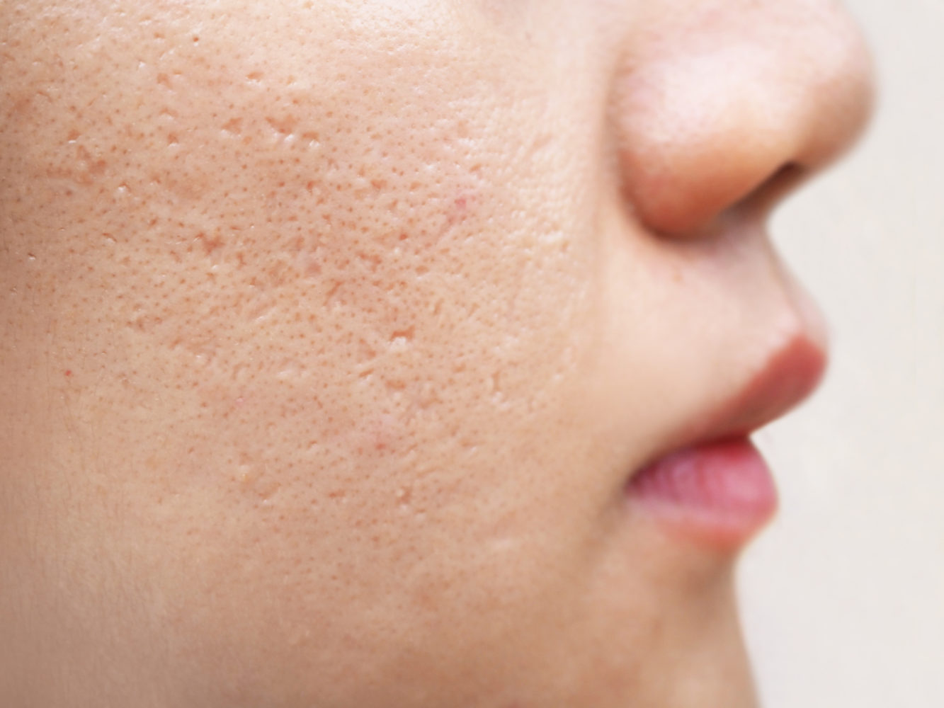 Acne treatment Beverly Hills, CA