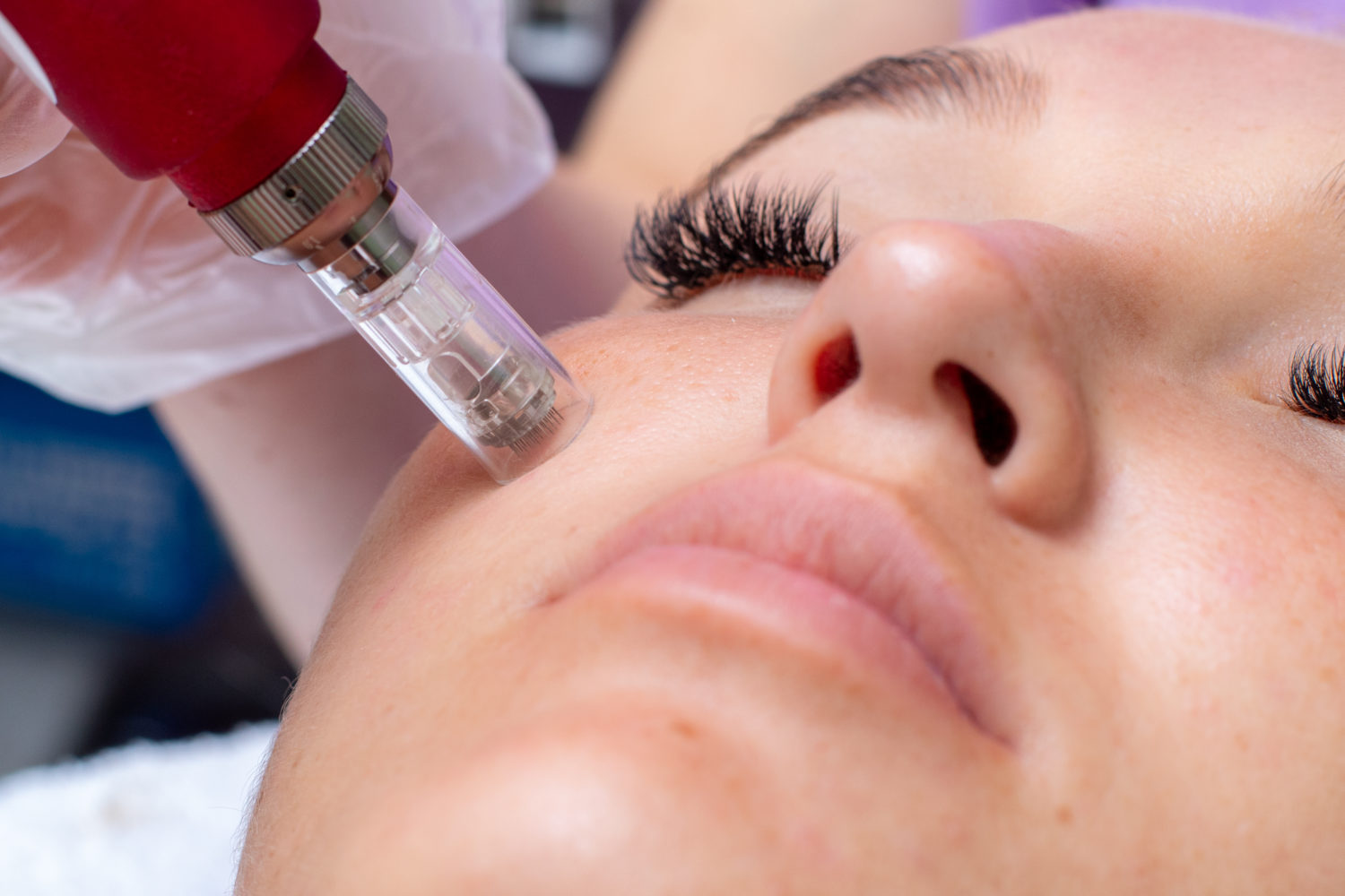 Microneedling Beverly Hills CA