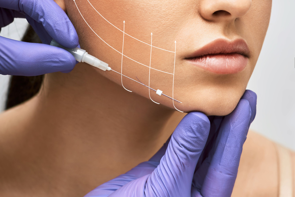 Thread lifts Beverly Hills