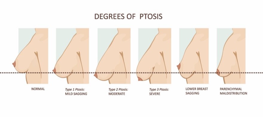 Breast Ptosis, Droopy Breasts, Saggy Breasts