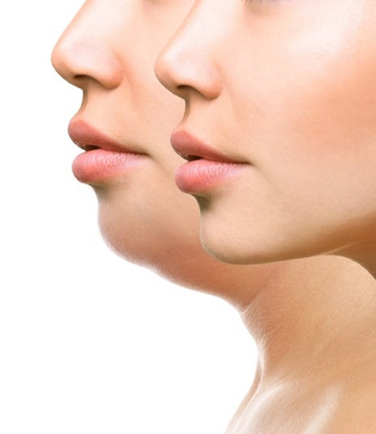 Kybella for double chin Beverly Hills