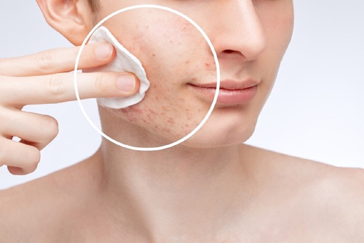 Laser skin resurfacing Beverly Hills